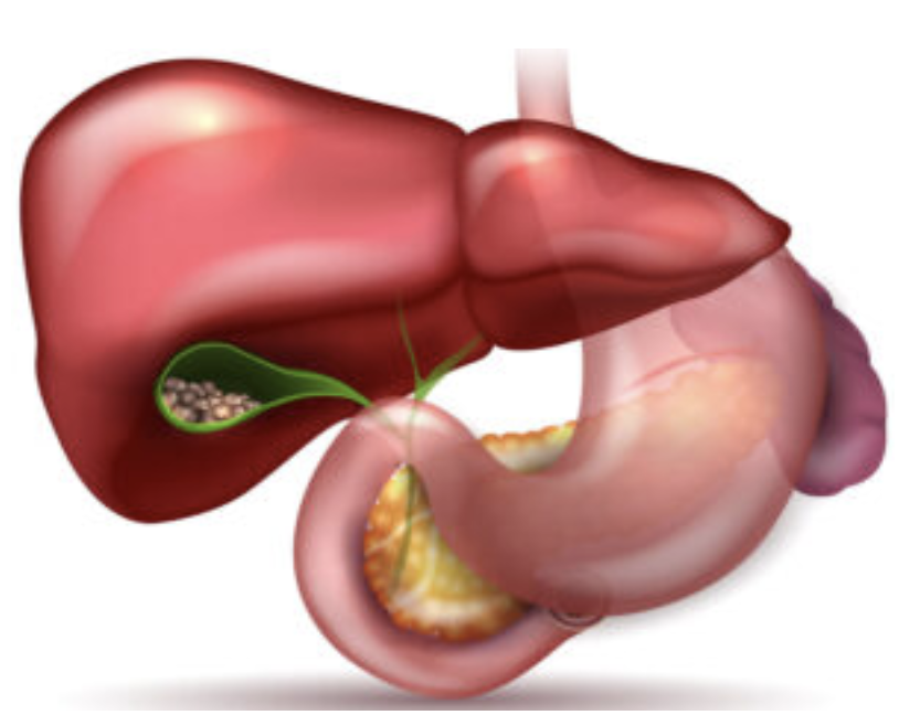 Cataract illustration